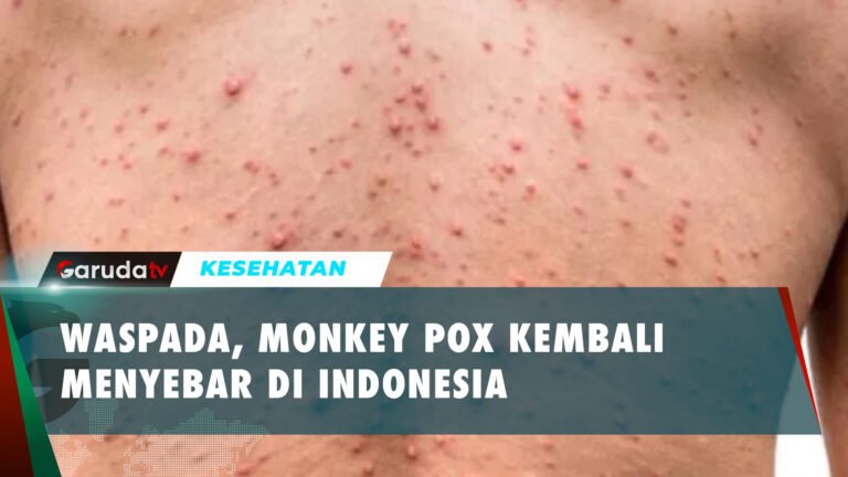 Waspada! Monkey Pox Kembali Mewabah di Indonesia