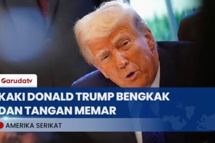 Trump Alami Pembengkakan Kaki dan Memar di Tangan, Gara-gara Aspirin dan Jabat Tangan