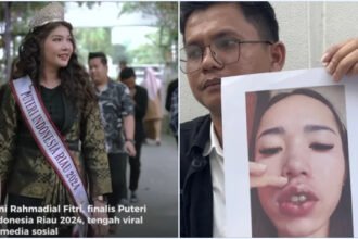 Eks Finalis Puteri Indonesia Diduga Bikin Cacat Puluhan Pasien, Resmi Jadi Tersangka
