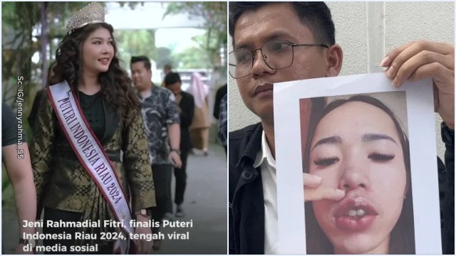 Eks Finalis Puteri Indonesia Diduga Bikin Cacat Puluhan Pasien, Resmi Jadi Tersangka
