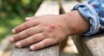 Tak Cuma Bentol, Ini Tanda Alergi pada Anak yang Wajib Diwaspadai Orang Tua